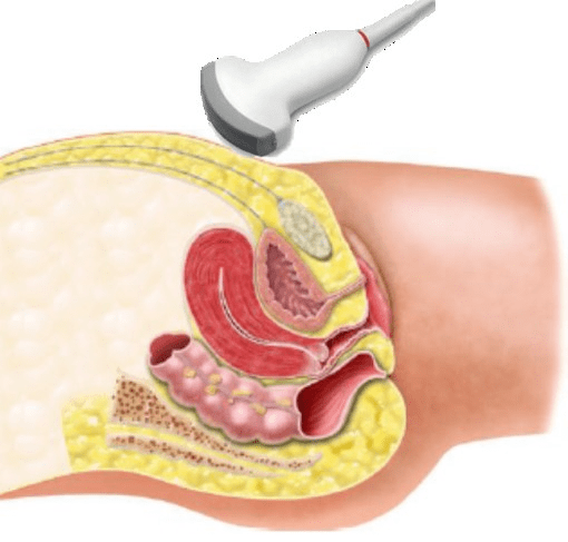 【友谊科普】妇科超声检查要注意什么?