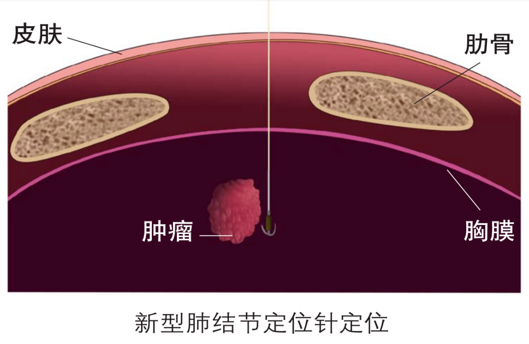 肺结节太小太软术中找不到了这招新技术至关重要