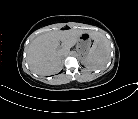 脾破裂ct图片