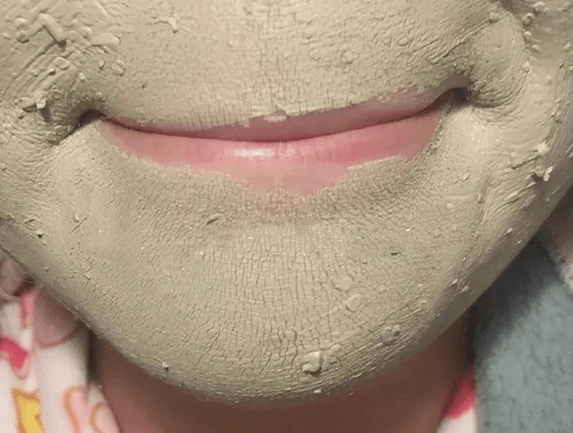 黑头洗完脸别擦水乳！漏掉这一步，难怪你黑头粉刺越来越多！
