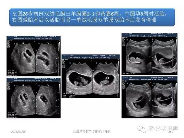 胎盘图片双胞胎图片