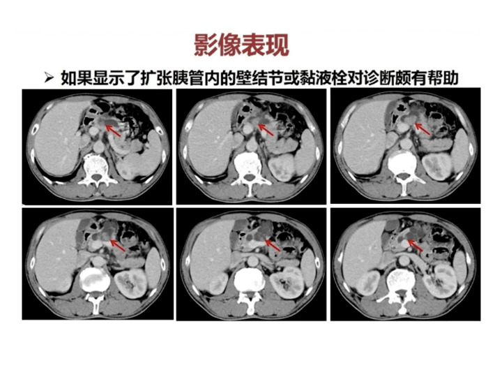 省立影像读片 胰腺病变 21 09