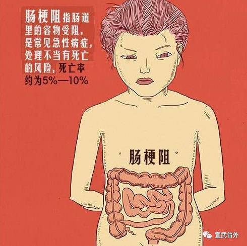 肠梗阻|莫让肠子堵，远离肠梗阻