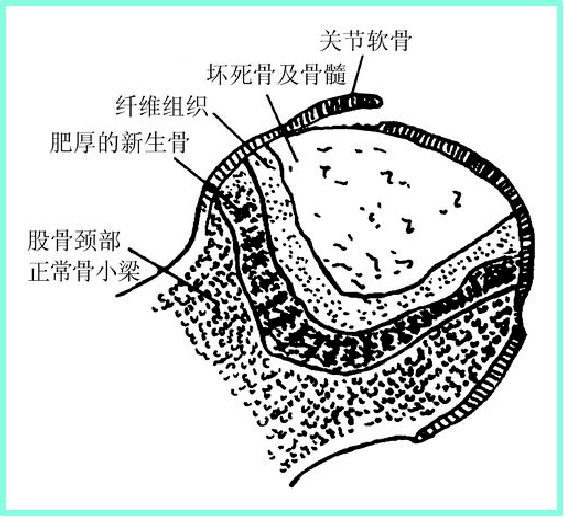 股骨干骺端图片图片