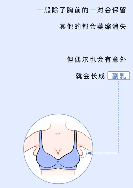 到腹股沟的两条线上我们很小很小很小的时候这也叫多乳症乳腺外科主任