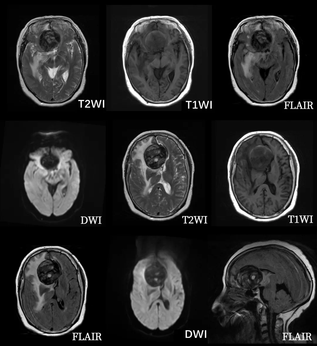 頭顱 mri 平掃如下:患者女 ,68 歲,頭昏痛 1 年,加重伴反應下降 1 月