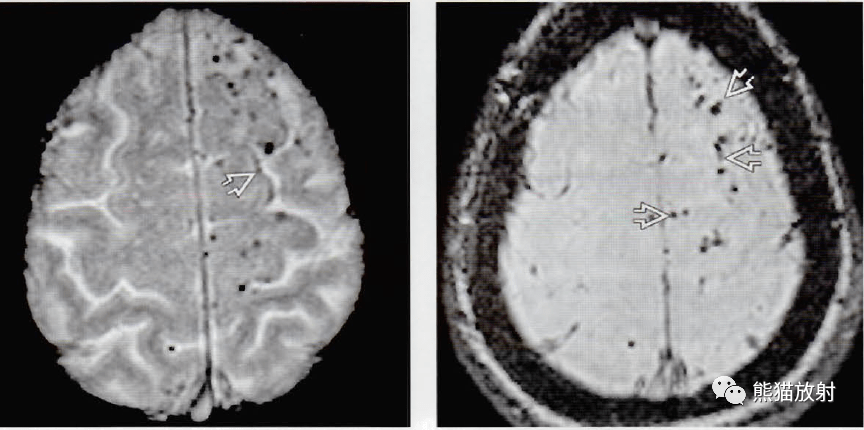 烟雾病脑淀粉样变性丨影像及临床诊断要点