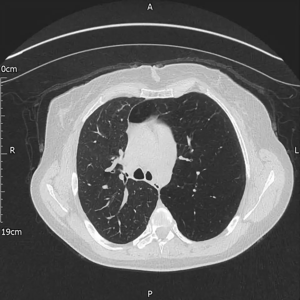大叶性肺叶图片图片