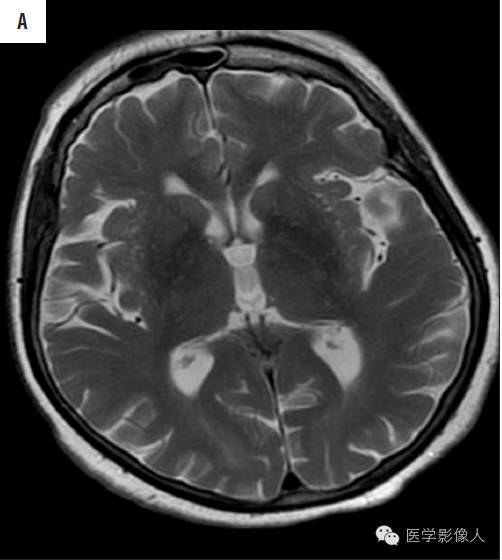 黄素环|脑内T2WI上低信号病变大致分为8大类【总结】