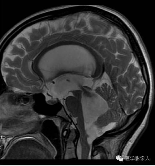 黄素环|脑内T2WI上低信号病变大致分为8大类【总结】