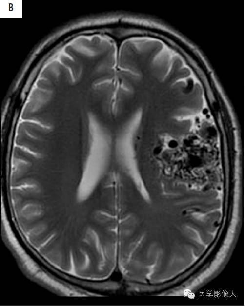 黄素环|脑内T2WI上低信号病变大致分为8大类【总结】