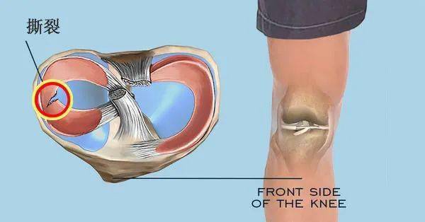 半月板損傷主要包括兩種,一是半月板撕裂性損傷,多見於年輕人;另一個