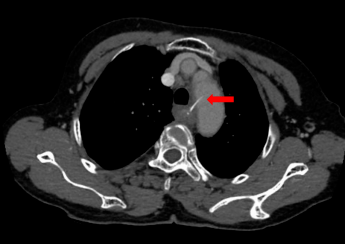 耳鼻|鱼刺卡喉，吞了口饭险夺命！医生提醒→