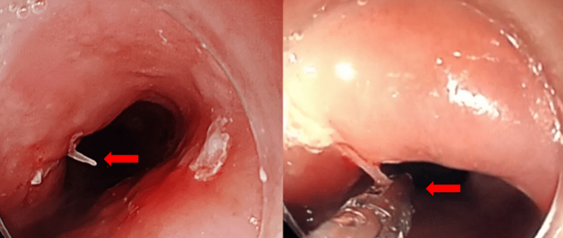 耳鼻|鱼刺卡喉，吞了口饭险夺命！医生提醒→