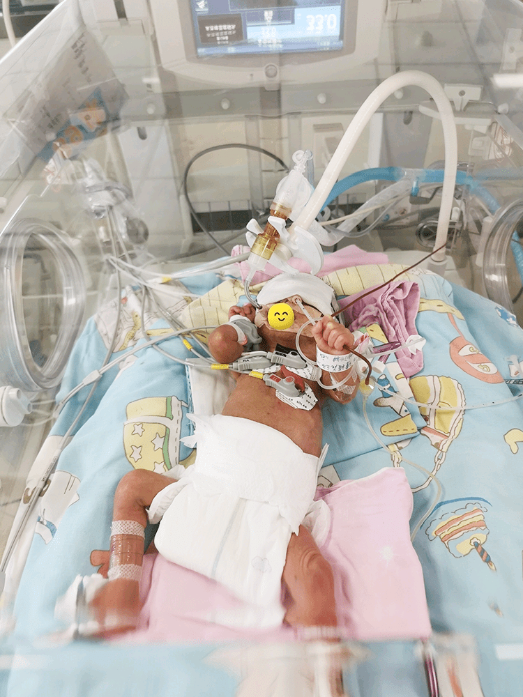 家庭参与式护理救治"巴掌大"早产儿!