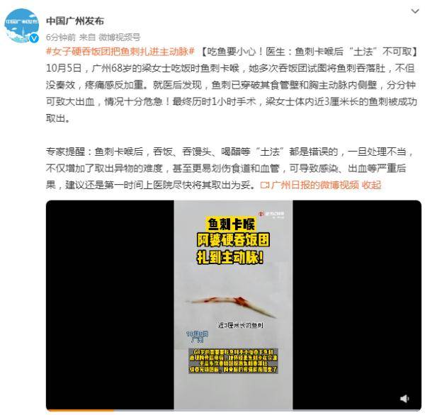 饭团|吃鱼要小心！医生：鱼刺卡喉后吞饭、吞馒头、喝醋等“土法”不可取