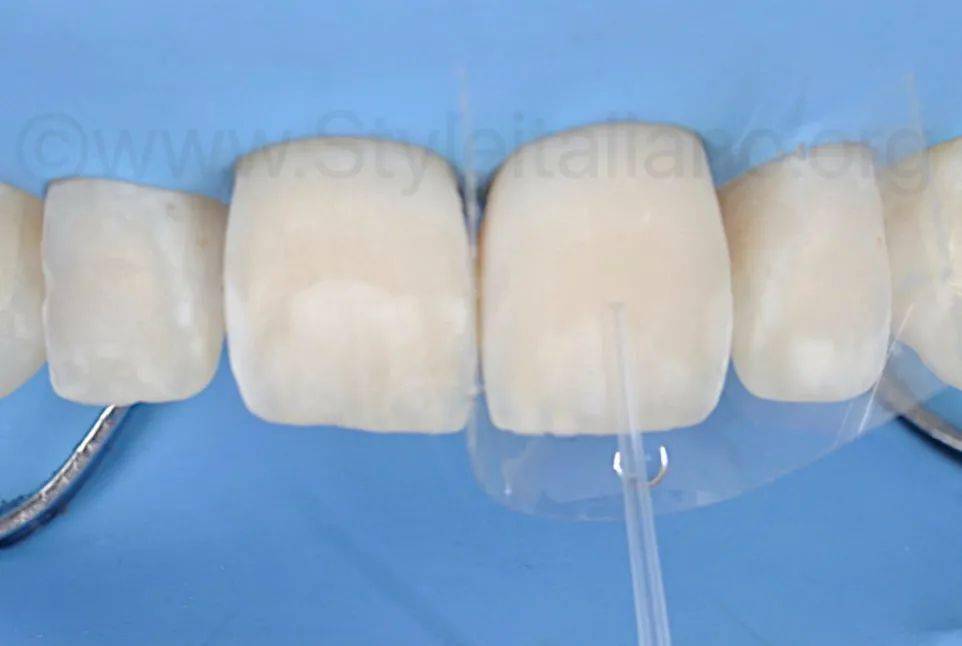 牙医学堂渗透树脂治疗前牙大面积釉质白斑