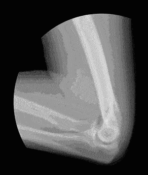 炎症|不穿秋裤会冻出关节炎吗？真相是……