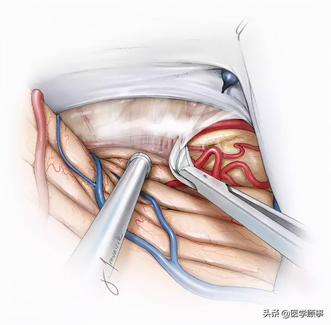 後顱凹天幕腦膜瘤手術策略與技巧