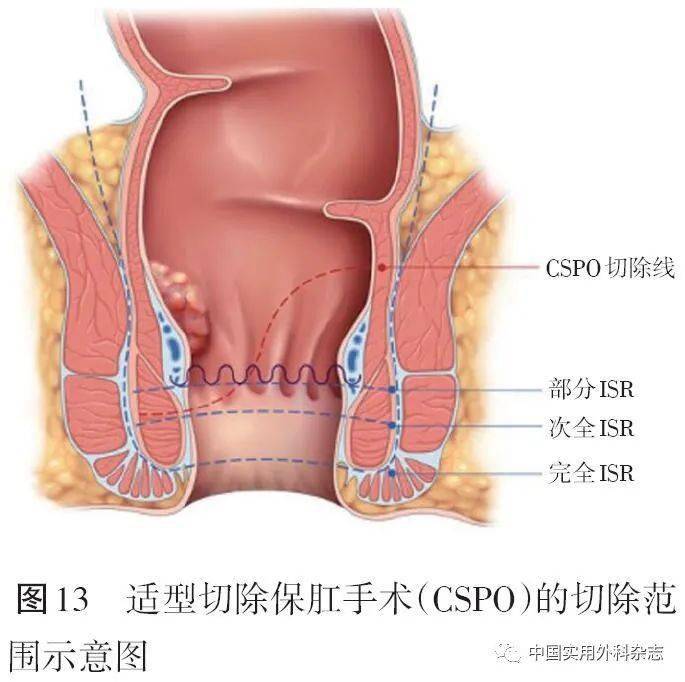 直肠癌术后吻合器图解图片