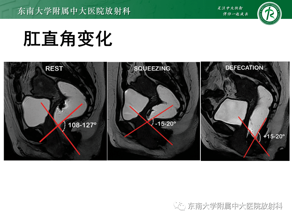 盆腔臟器脫垂mri影像