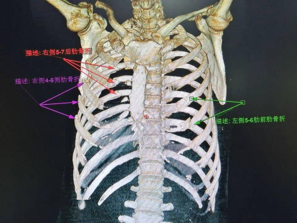 醫療動態我院胸外科完成一例雙側肋骨骨折複合固定手術