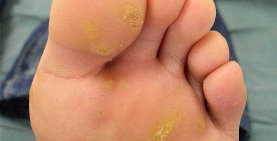 皮肤鸡皮疙瘩hpv(皮肤鸡皮疙瘩状颗粒是什么原因导致)