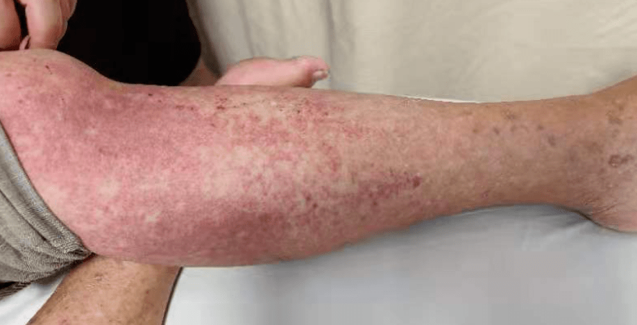 病例|慎买！女子自行买药治痛风，全身皮疹险丧命