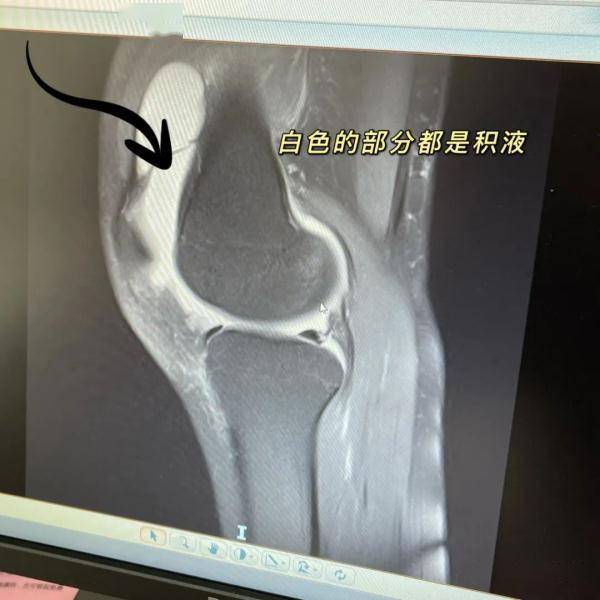 运动|23岁杭州姑娘因为裤子太短…进了医院