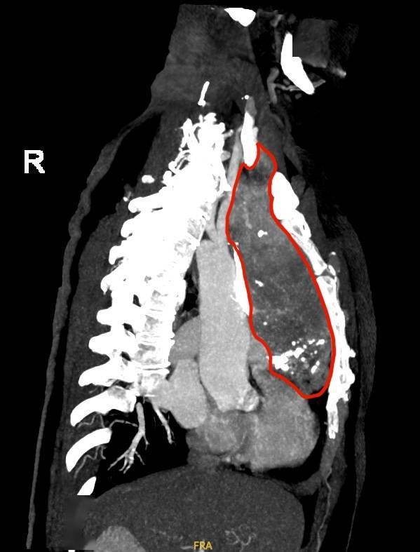 团队|甲状腺肿深入胸腔“顶心顶肺”，团队携手为老太胸口卸肿物