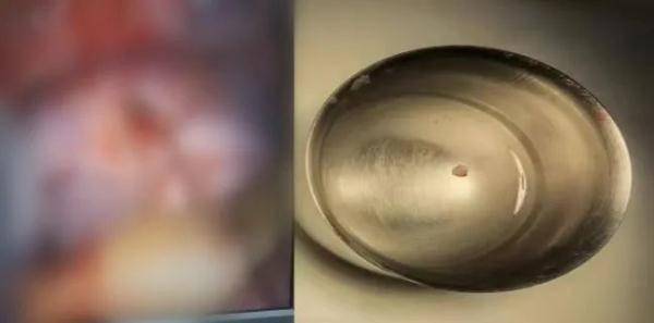 听神经|男子眼皮底下一直跳，到医院一查：结果惊出冷汗