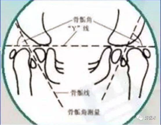 骨科常用的角度測量方法彙總,全在這裡了!_cobb