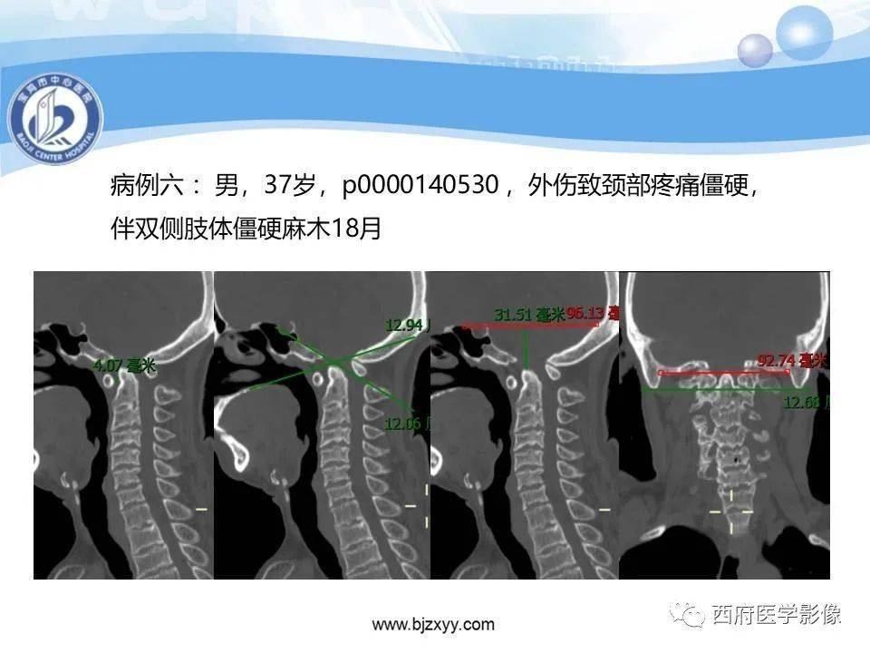 颅底凹陷症的影像诊断与鉴别诊断