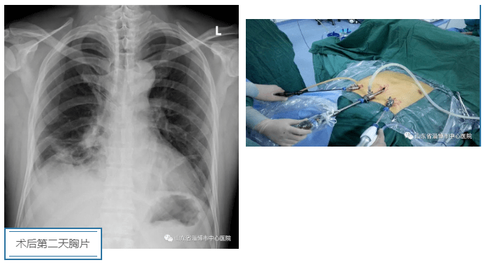 剑突下微创时代淄博市中心医院成功实施胸腔镜剑突下巨大胸腺瘤切除术