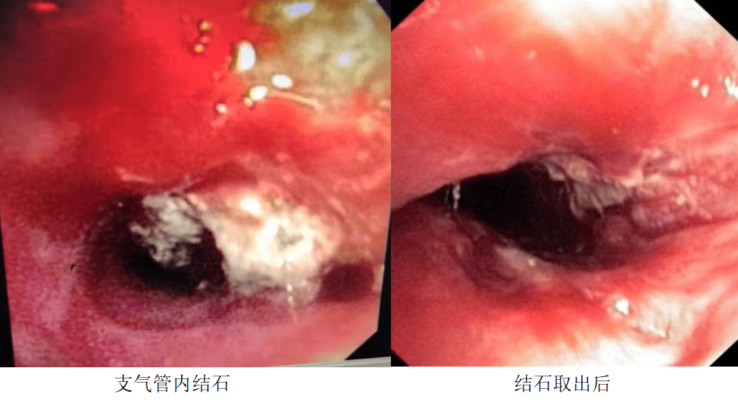将左主支气管的管腔绝大部分堵塞,质地极硬,考虑支气管巨大结石