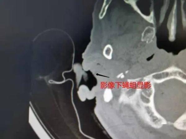 蛆虫|吓一跳！大理80岁老奶奶耳朵里取出20条活蛆