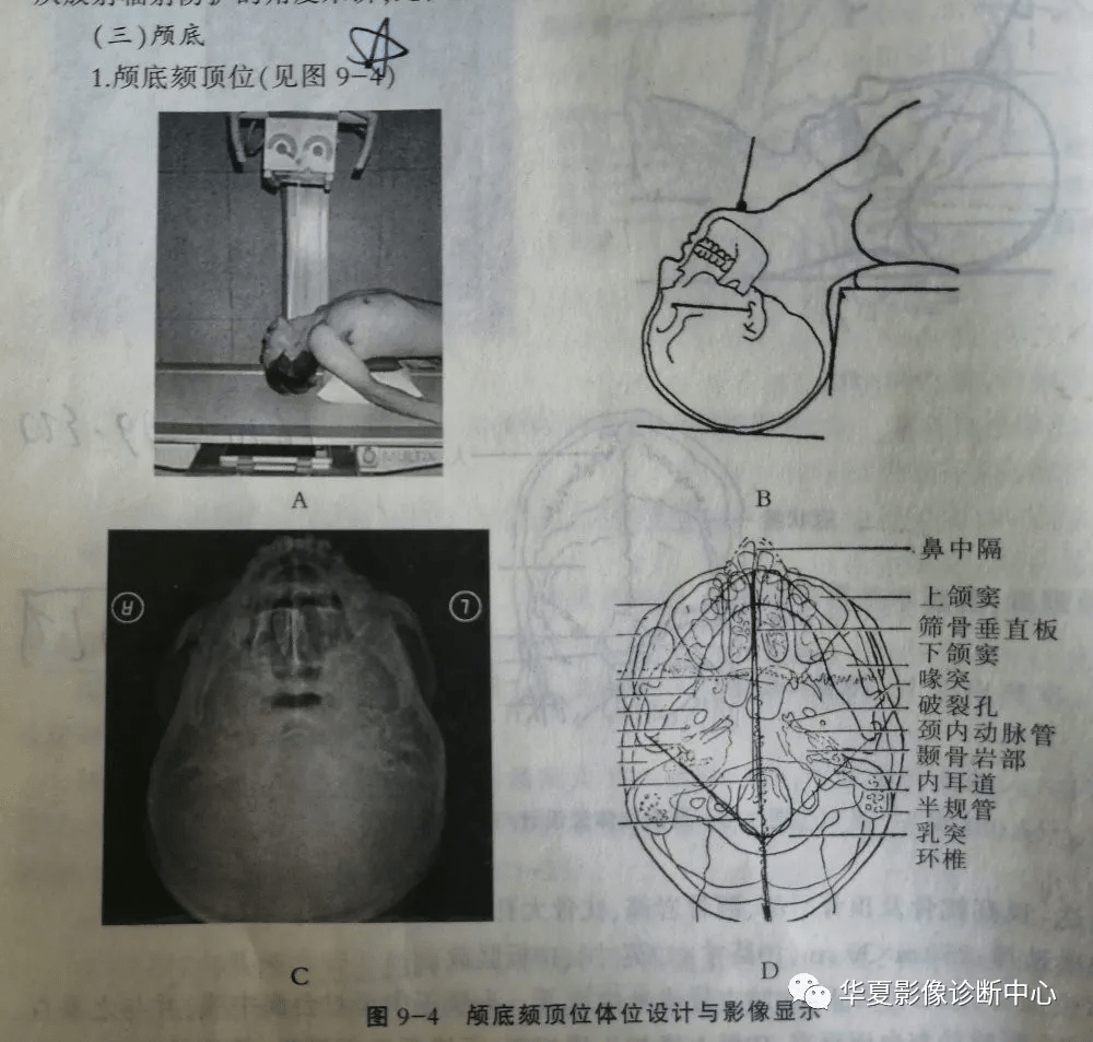 颧弓x线的摄影体位图片