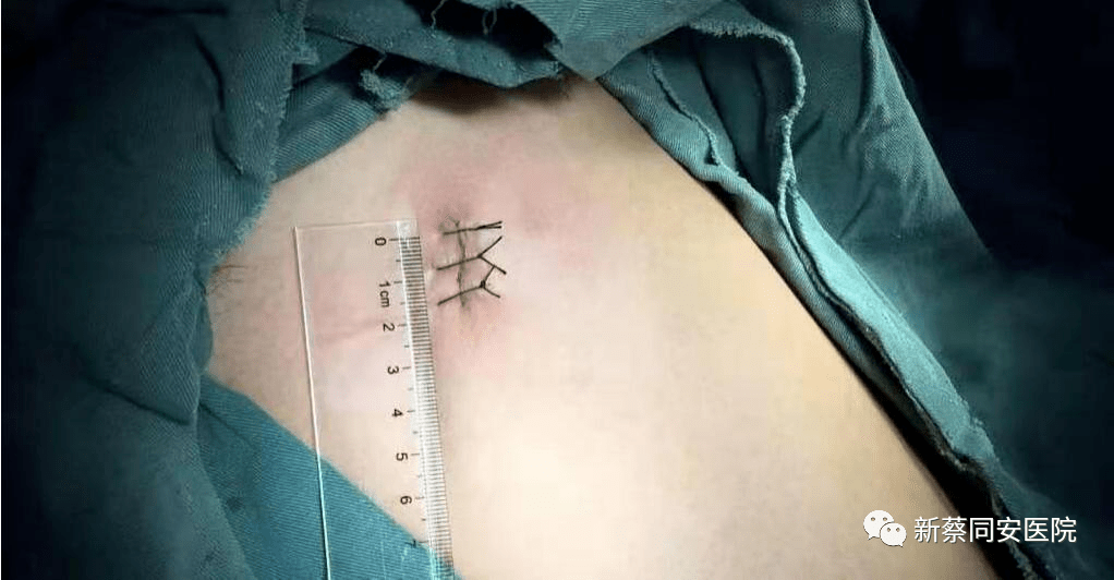 【同安一招鲜】患者如何面对"不速之客"——肺结节