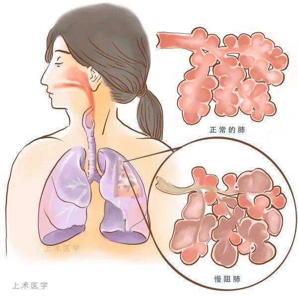 慢阻肺已是我国第四大死因预防慢阻肺要注意这五点