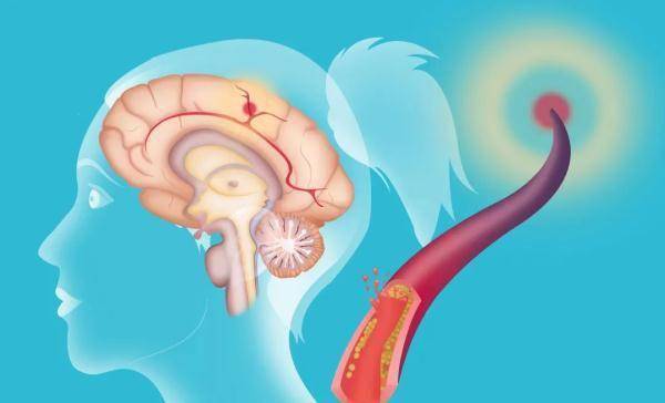 Speech|世界卒中日 | 这个习惯不改，卒中常伴身边