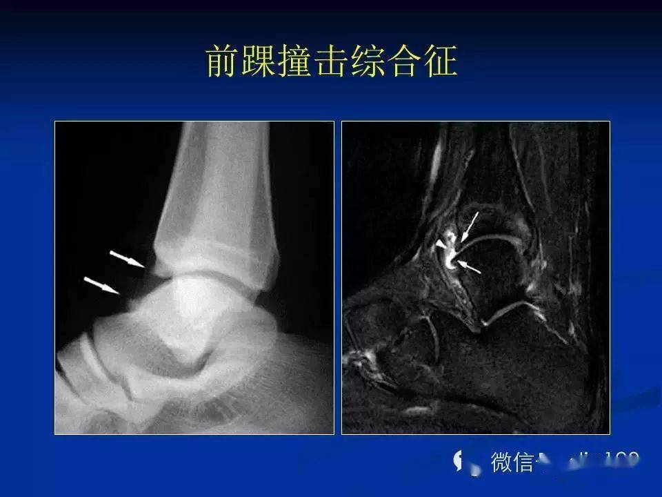 踝关节撞击综合征影像学表现