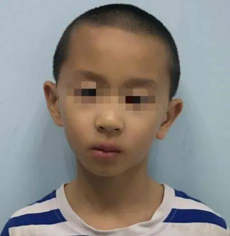 垂直性斜视患儿出现歪头及面部发育轻度不对称