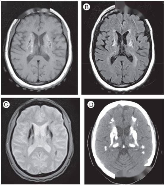 进行|脑出血CT的9大“陷阱”，稍不留神就会误诊