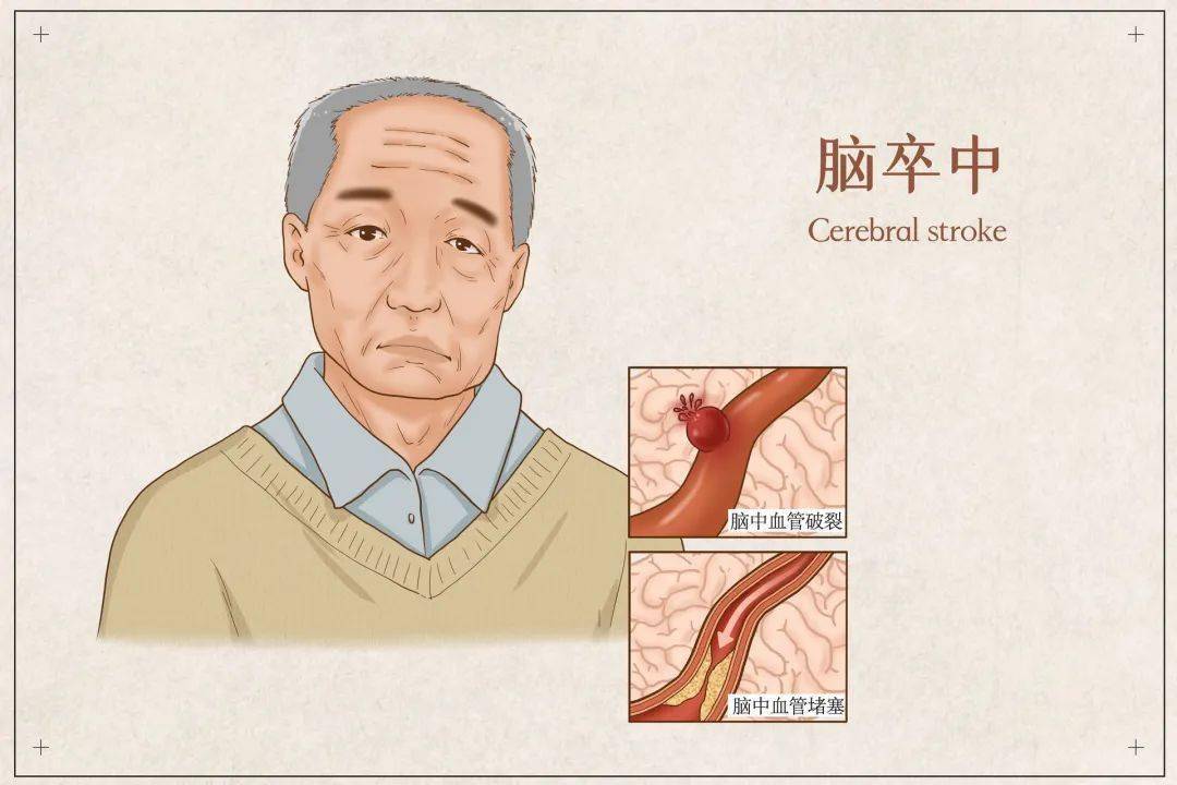 治疗|世界卒中日 | 远离脑卒中,至少要知道这几点