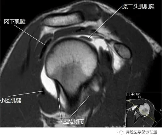 影像解剖肩关节磁共振断层