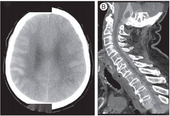 进行|脑出血CT的9大“陷阱”，稍不留神就会误诊