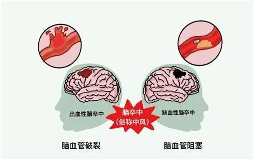 治疗|【科普】“世界卒中日”宣传要点