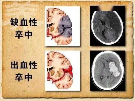 梗死）和出血性卒中。其中脑梗死是主要卒中类型，占卒中总数的70%左右。缺血性卒中：血管堵塞 出血性卒