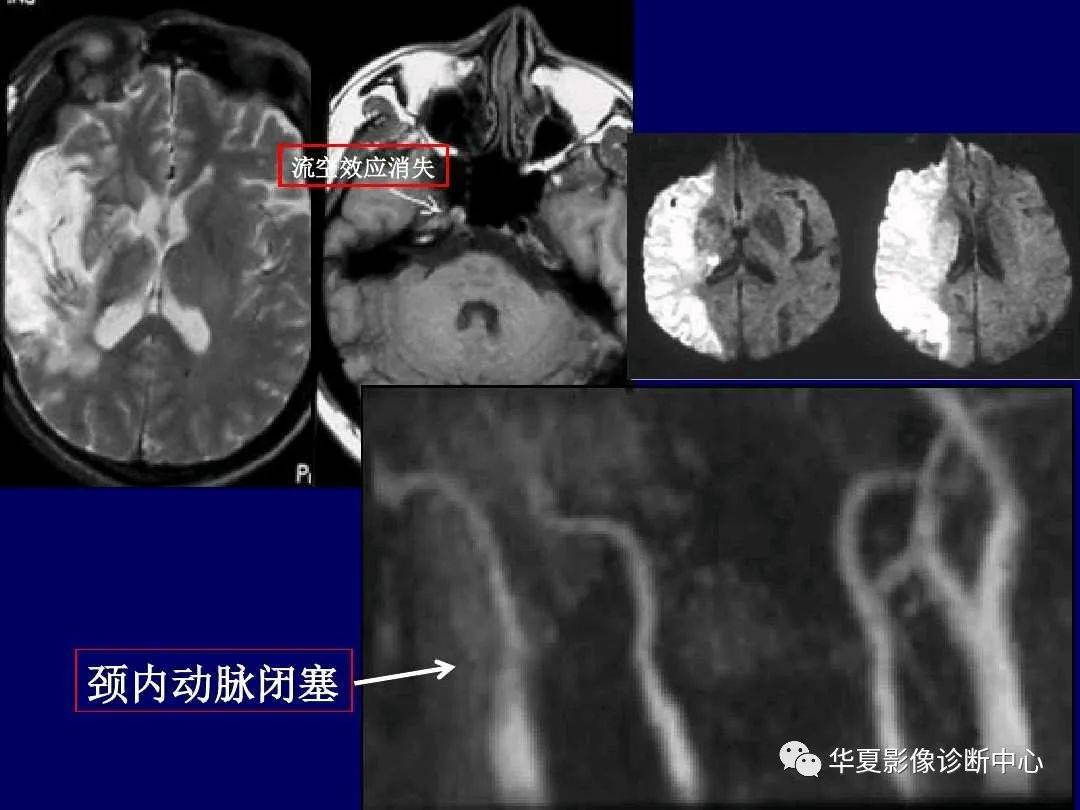 诊断|缺血性脑血管病的影像诊断