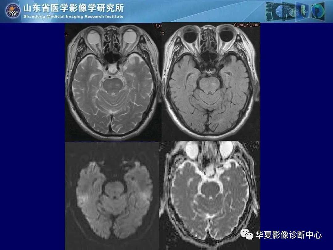 诊断|缺血性脑血管病的影像诊断